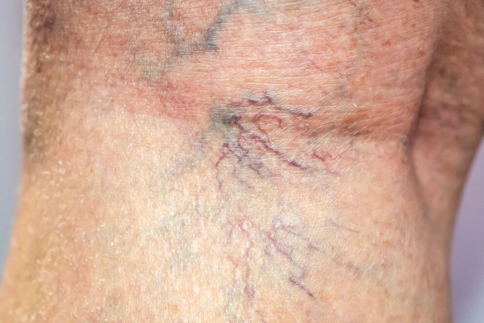 Vene varicose sul corpo