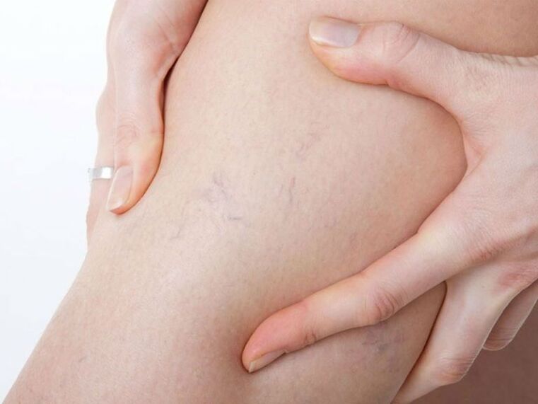 Vene varicose sulle gambe