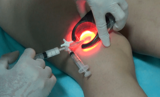 La scleroterapia è un metodo efficace per il trattamento delle vene varicose sulle gambe