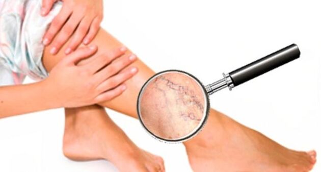 Vene varicose sulle gambe