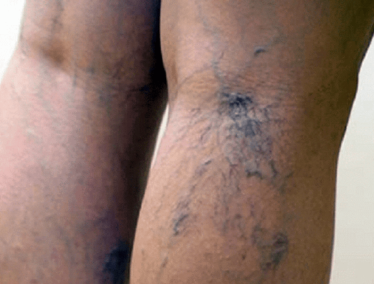 Vene varicose sulle gambe